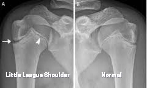 X-ray of little league shoulder in a pediatric patient.