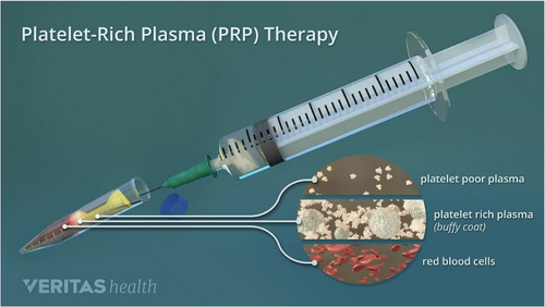 diagram of platelet-rich plasma injection