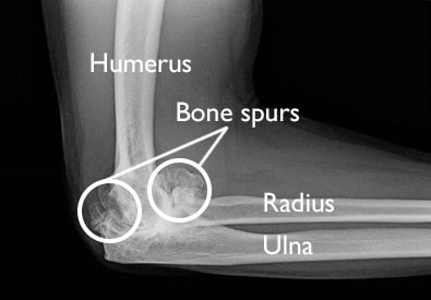 bone spurs in an x-ray of an elbow