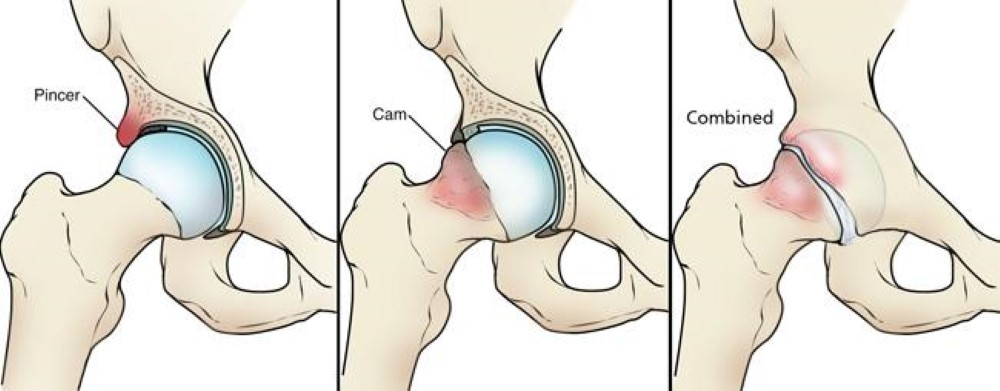 Types of hip impingement