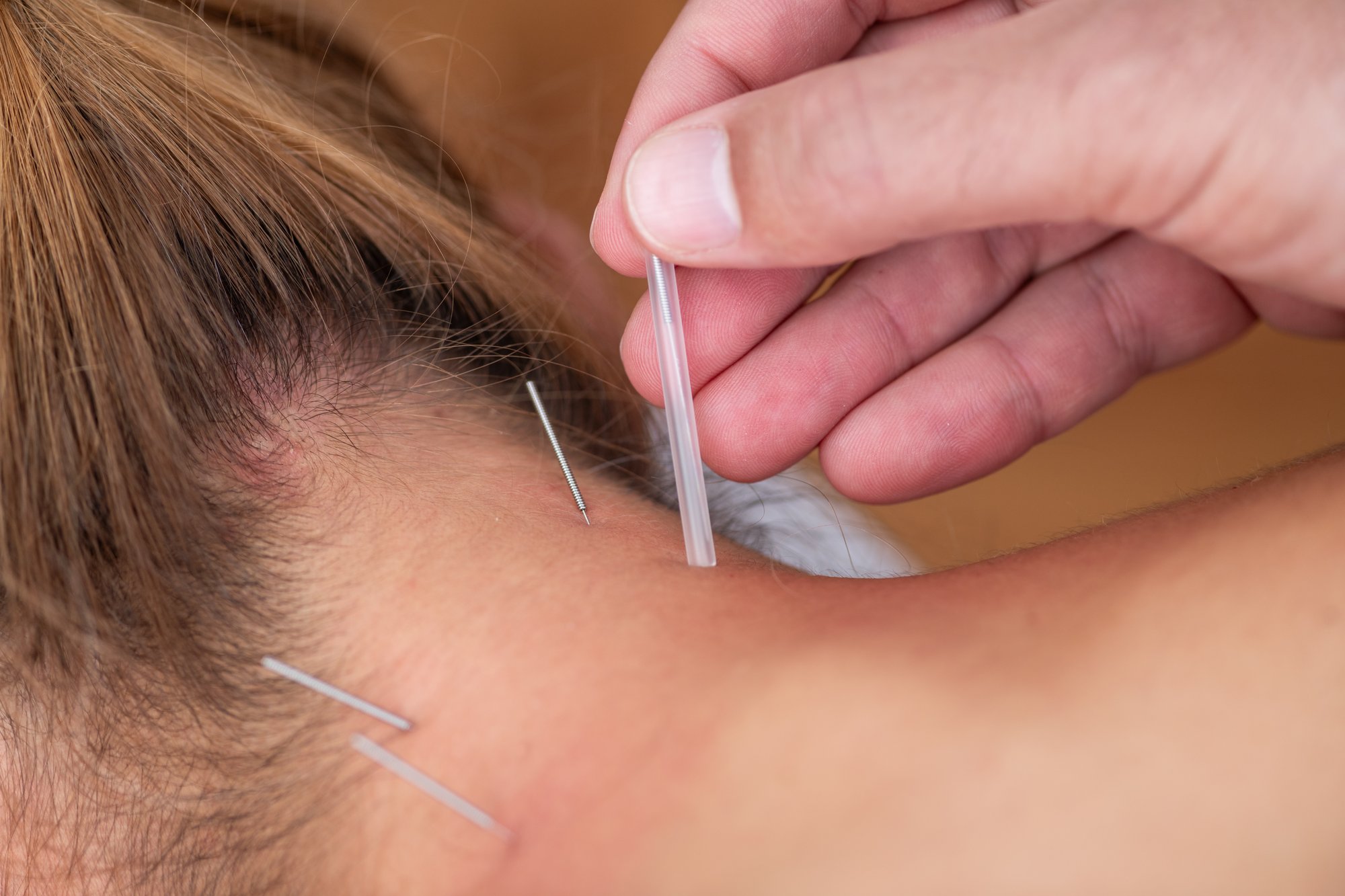a-physical-therapist-performs-dry-needling-on-a-pa-2024-11-22-03-06-17-utc