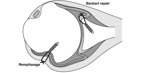 shoulder instability surgical repairs