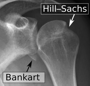 bony bankart and hill-sachs lesions