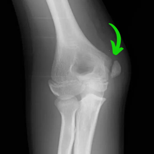 X-ray image of a pediatric patient with little league elbow.