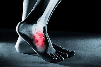 Running Injuries, Pt 2: Stressed Out By a Stress Fracture?