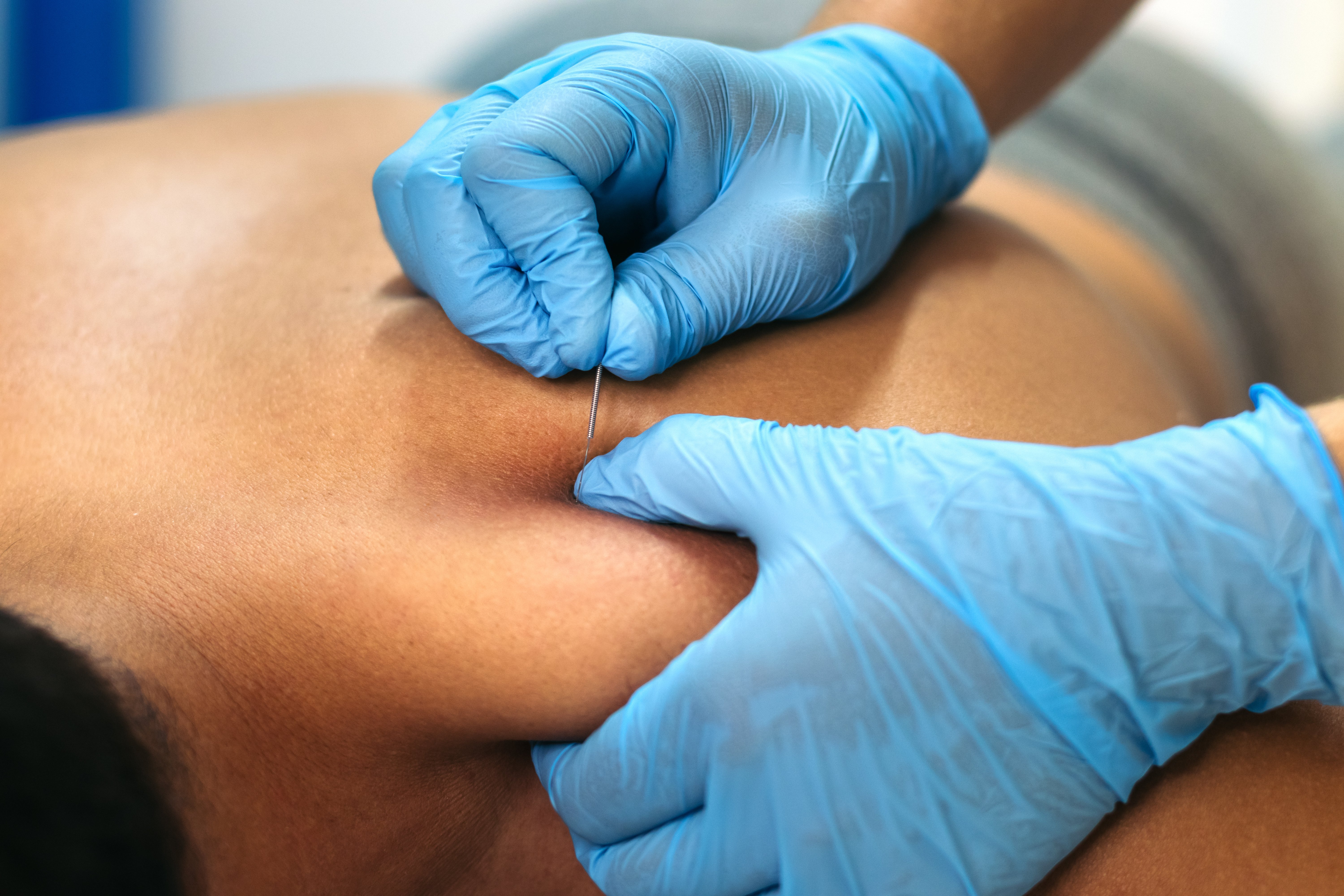 physiotherapy-clinic-dry-needling-2024-04-10-17-16-43-utc (1)